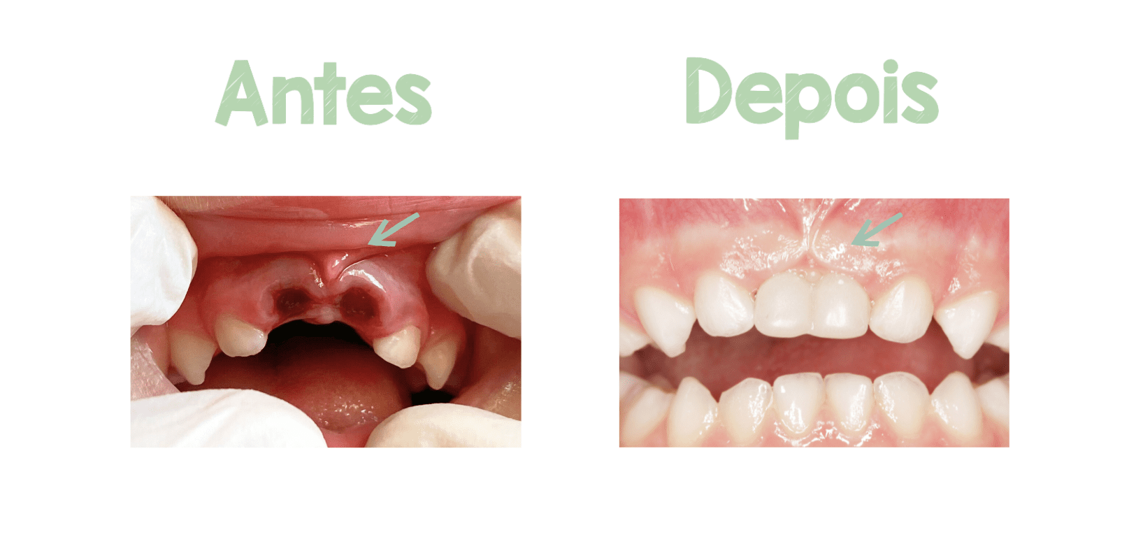 Quando é Indicada a Terapia Miofuncional?
