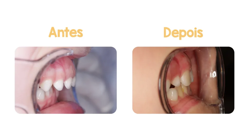 Terapias Complementares para Corrigir Padrões de Sucção